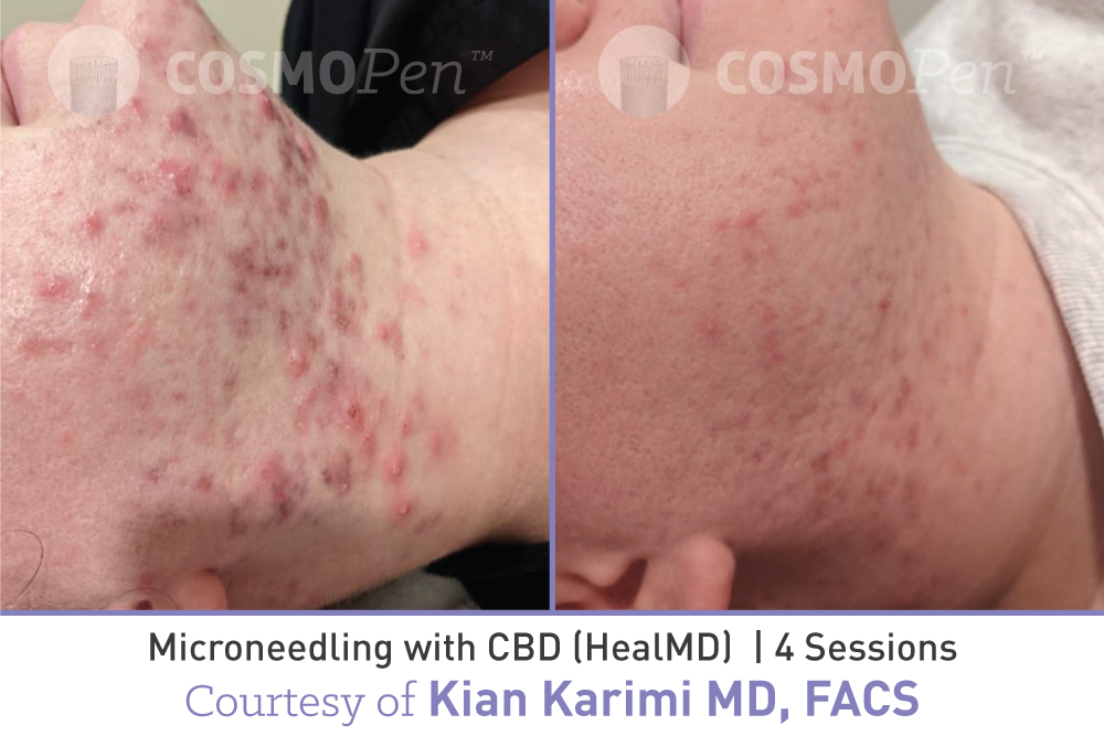 treatment with cosmopen and healmd