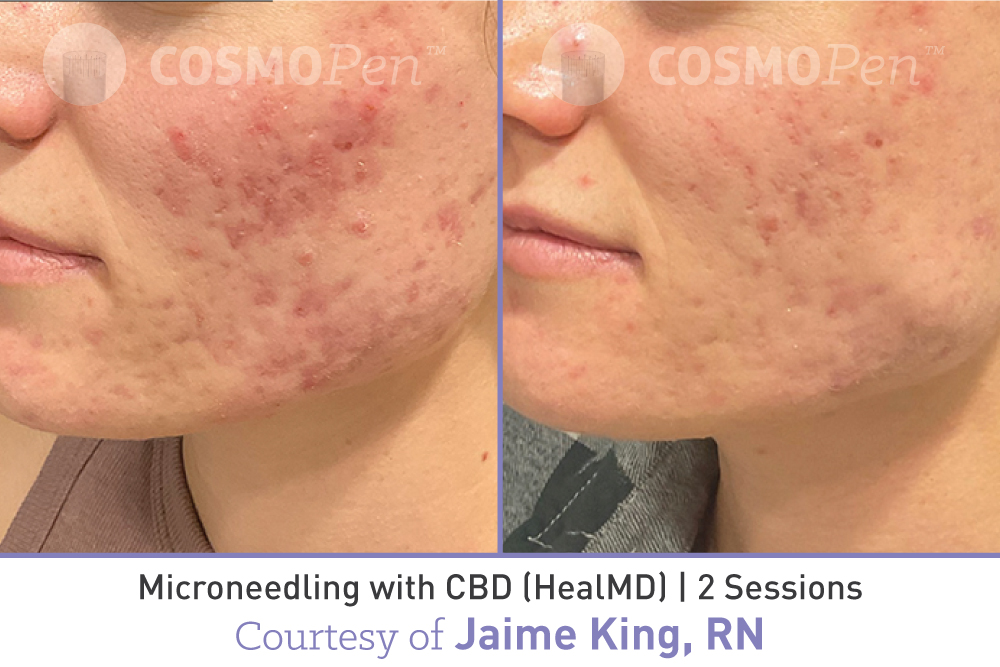 treatment with cosmopen and healmd