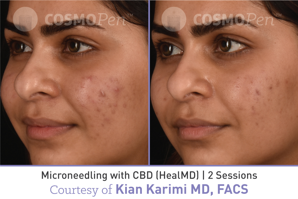 treatment with cosmopen and healmd